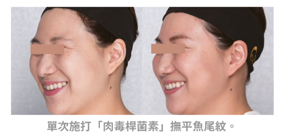 肉毒桿菌素